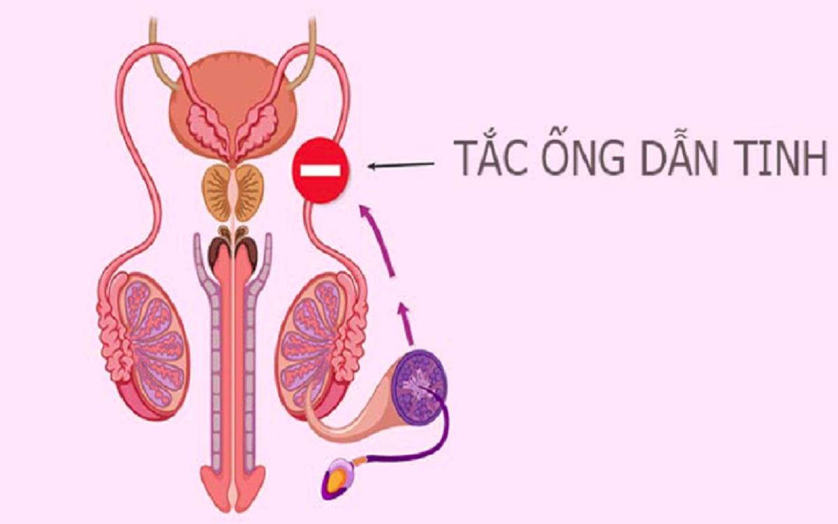 Dấu hiệu vô sinh ở nam - Nguyên nhân, triệu chứng & Điều trị 7 Nguyên nhân gây vô sinh nam rất đa dạng, từ yếu tố bẩm sinh đến thói quen sinh hoạt (Ảnh: Sưu tầm internet)
