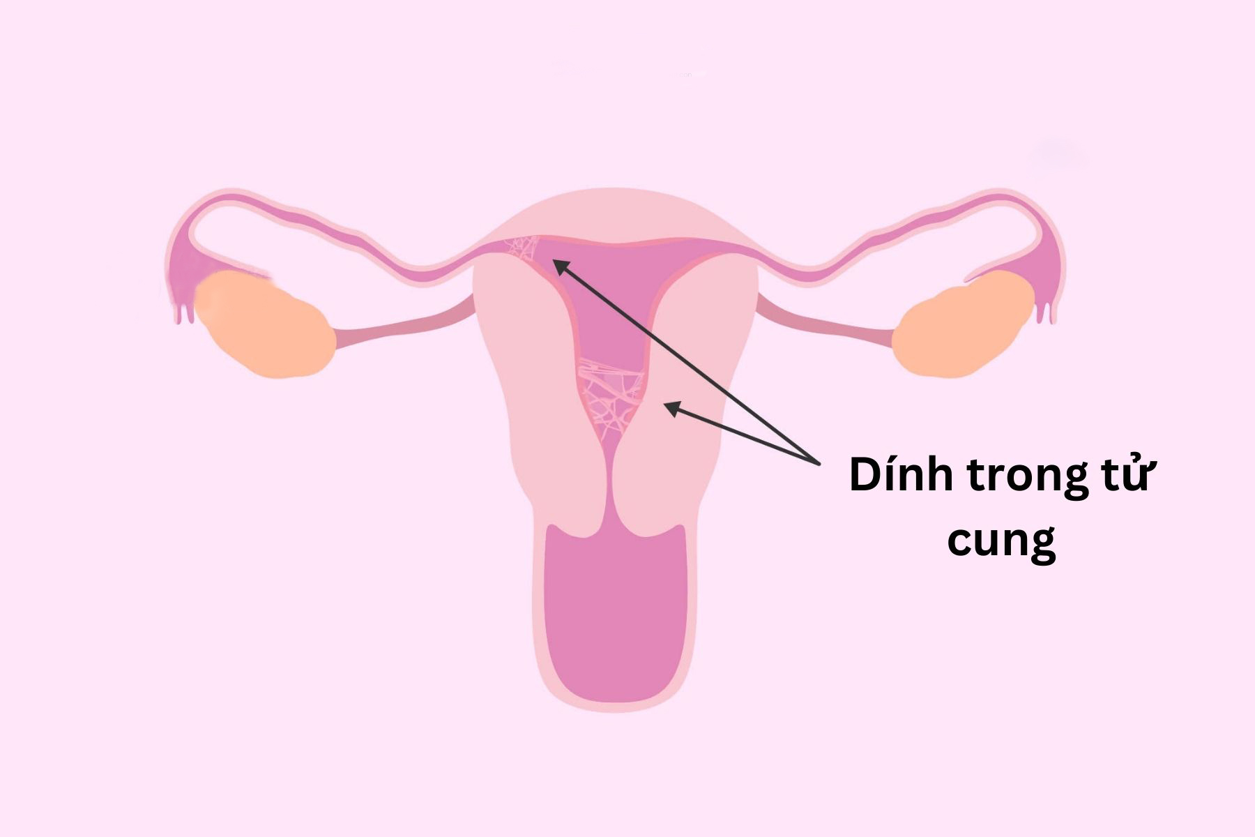 Dính buồng tử cung có thai được không? Chuyên gia giải đáp 5 Dính buồng tử cung là một trong những nguyên nhân gây vô sinh thứ phát (Ảnh: Sưu tầm internet)