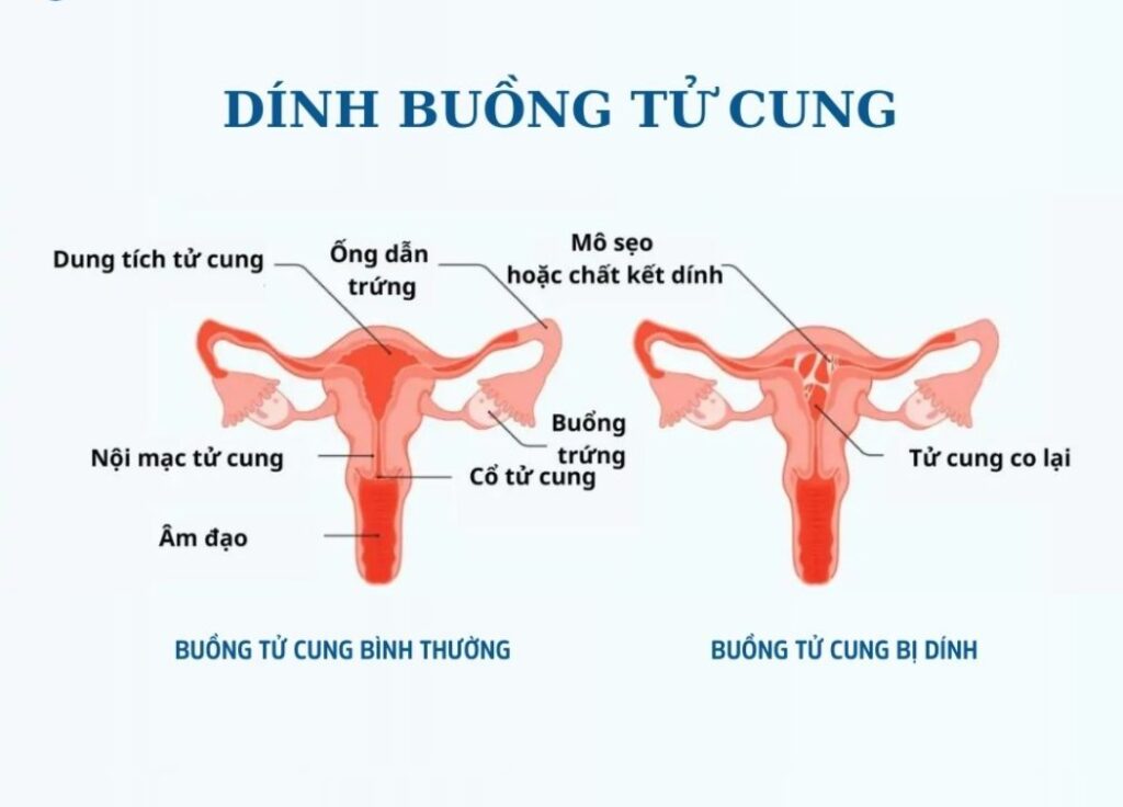 Dính buồng tử cung có thai được không? Chuyên gia giải đáp 4 Các thủ thuật can thiệp vào tử cung là nguyên nhân hàng đầu gây dính buồng tử cung (Ảnh: Sưu tầm internet)