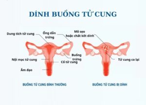 Các thủ thuật can thiệp vào tử cung là nguyên nhân hàng đầu gây dính buồng tử cung (Ảnh: Sưu tầm internet)